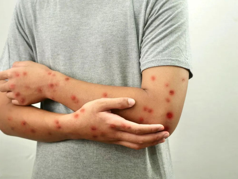 Kyrgyzstan reports over 9,000 measles cases, despite decline 