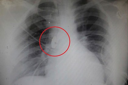 Foto: Respiratory Medicine Case Reports