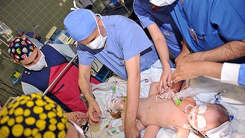 Saudiyalik shifokorlar yamanlik Siam egizaklarini muvaffaqiyatli ajratdi