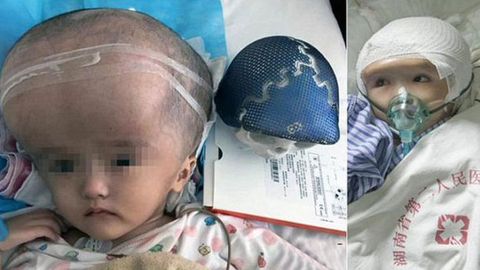 Xitoyda uch yoshli qizchaga 3D-printerdan chiqarilgan miya suyagi o‘tqizildi