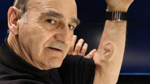 Avstraliyalik professor o‘z qo‘lida Wi-Fi orqali ishlaydigan uchinchi quloq “o‘stirdi”