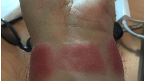 Britaniyalik ayol Apple Watch’ni taqib, bilagini kuydirib oldi