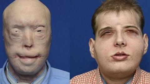 AQShda kuyib qolgan o‘t o‘chiruvchiga yangi yuz ko‘chirib o‘tkazishdi