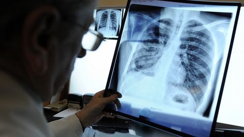 Litvada o‘qituvchi ayol 77 nafar o‘quvchisiga sil yuqtirgani ma’lum bo‘ldi