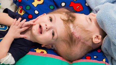 AQShda bir yoshli Siam egizaklari muvaffaqiyatli ajratildi