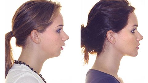 Breketlardan keyin yuz qanday o‘zgaradi?