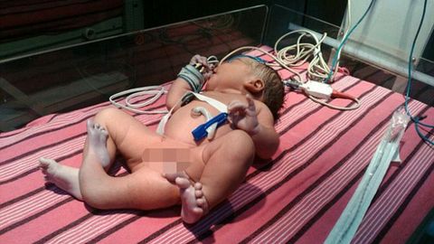 Ҳиндистонда уч оёқли қизча туғилди