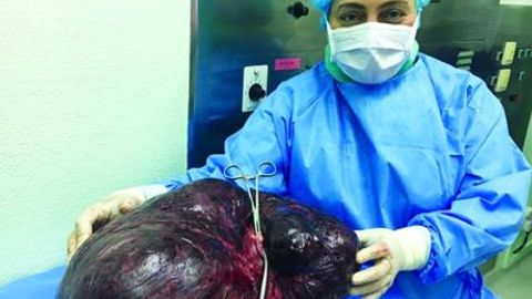 Dubayda jarrohlar 40 yoshli ayoldan 17,5 kilogrammli o‘simtani olib tashladi
