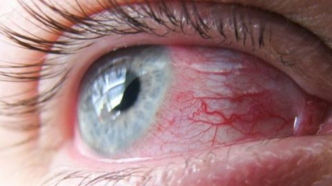 Kon’yunktivit: nima uchun ko‘zlar qizaradi va ularni qanday davolash kerak?