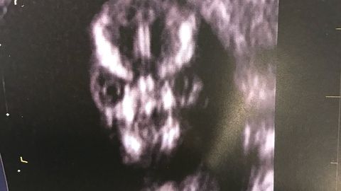 Yuzi Volan-de-Mortni eslatuvchi tug‘ilmagan go‘dak onasi va ijtimoiy tarmoq foydalanuvchilarini qo‘rquvga soldi