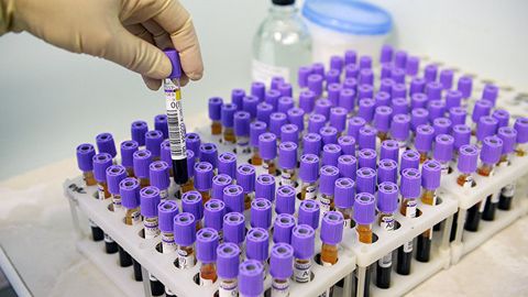 BMT: Rossiya OIV infeksiyasi yuqtirishning yangi holatlari bo‘yicha dunyoda uchinchi o‘rinda turibdi