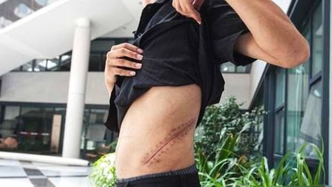 Xitoylik yigit iPhone uchun buyragini sotib, nogiron bo‘lib qoldi