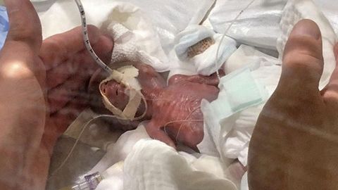 Yaponiyalik shifokorlar 268 gramm vazn bilan tug‘ilgan chaqaloqning hayotini saqlab qoldi
