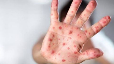 Филиппинда бир ойда 70 киши қизамиқ эпидемиясидан вафот этди