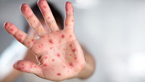 2019 йилнинг дастлабки ойида дунёда 100 мингдан ортиқ одамлар қизамиққа чалинди