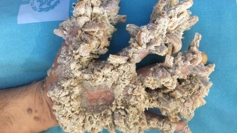 Isroilda “daraxt-odam” davolandi. Bu boshqalarga ham umid beradi