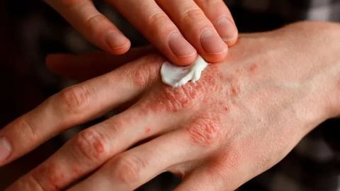 Хавфли, аммо юқумли эмас: Псориаз билан касалланганлар нималарга эътибор бериши керак?