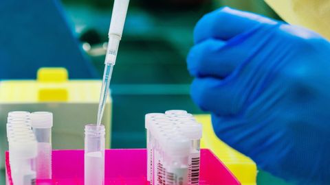 Dunyo bo‘ylab 23 mamlakatda 260 ga yaqin kishida maymunchechak tasdiqlandi — JSST