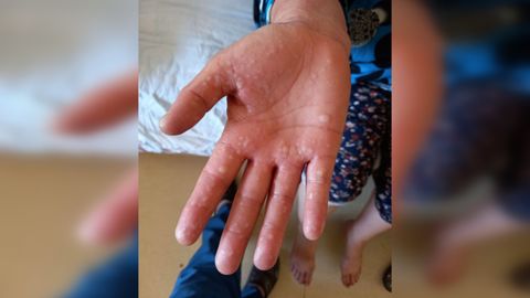 Andijonda ayol maymunchechak kasalligiga chalingani haqidagi xabarlarga raddiya berildi