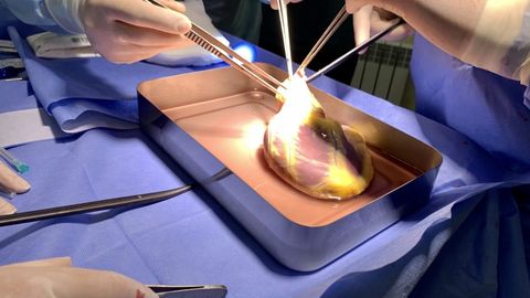 O‘zbekistonda yaqin kelajakda ilk bor yurak transplantatsiyasi amalga oshiriladi