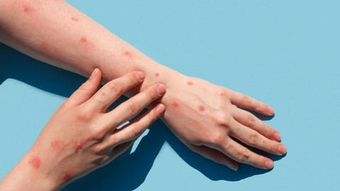 Uzbekistan registers 164 measles cases since advent of 2023