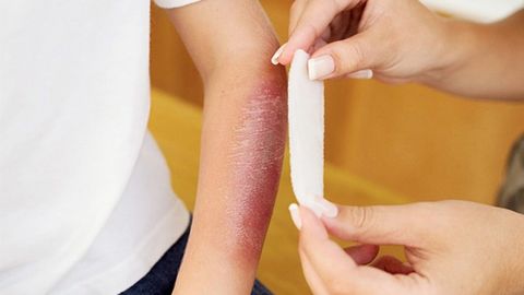 Биринчи ёрдам: нима учун куйган жойга муз қўйиш мумкин эмас?