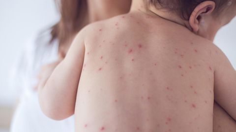 Alarming surge in measles cases in Kazakhstan sparks urgent action