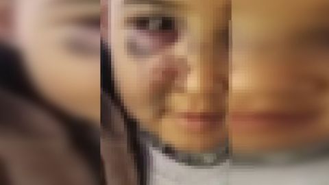 Самарқандда кўзи кўкарган болакайни отаси калтакламагани аниқланди