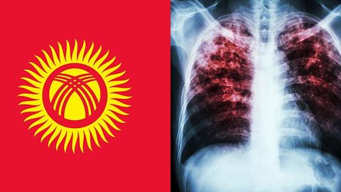 Kyrgyzstan secures $27.8 mn Global Fund grant for tuberculosis and AIDS treatment&nbsp;&nbsp;