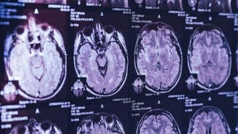 Канадалик олимга миянинг сирли касаллигини ўрганиш тақиқланди