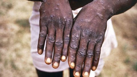 Hindistonda maymunchechakka qarshi vaksina ishlab chiqilmoqda