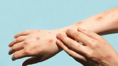 Uzbekistan population shows strong collective immunity against monkeypox, reports health authority&nbsp;