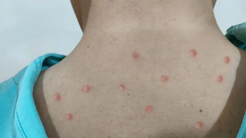 Qozog&lsquo;iston kasalxonalariga maymunchechakka tayyorgarlik ko&lsquo;rish buyurildi