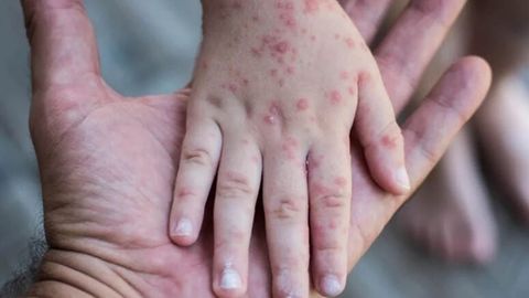 Rossiyada bog&lsquo;cha va maktablarda yangi virus tarqalmoqda