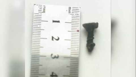 Qozog&lsquo;istonlik shifokorlar 4 yoshli bola burnida yarim yildan buyon turgan burama mixni olib tashladi (foto)