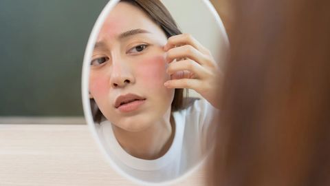 Dermatologlar tavsiyasi: e&rsquo;tibordan chetda qoldirmaslik kerak bo&lsquo;lgan teridagi o&lsquo;zgarishlar