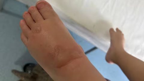 Namanganda 1,5 yoshli bolaning oyog&lsquo;i kuyib qoldi