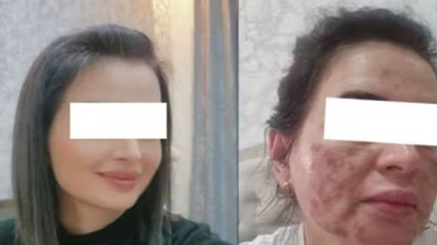 Toshkentdagi go&lsquo;zallik salonida ayolning yuzi 80 foiz kuydirib qo&lsquo;yildi&nbsp;