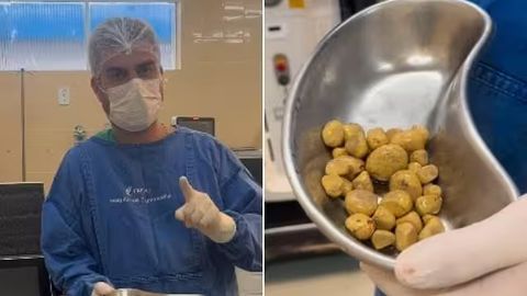 Braziliyada kolaga ruju qo&lsquo;ygan erkak organizmidan 35 ta tosh chiqdi (video)