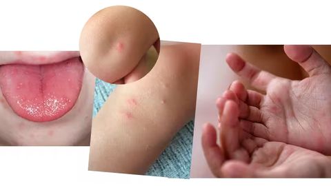 Koksaki qanday virus va u nimasi bilan xavfli?