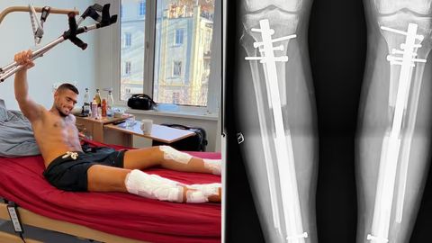 Germaniyalik yigit oyoq uzunligini 24 sm ga uzaytirish uchun ikkita jarrohlik amaliyotini boshdan kechirdi