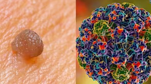 Papilloma nima va u qanday paydo bo&lsquo;ladi?