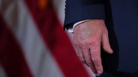 Donald Trampga surunkali venoz yetishmovchiligi tashxisi qo&lsquo;yildi. Bu xavfli kasallikmi?