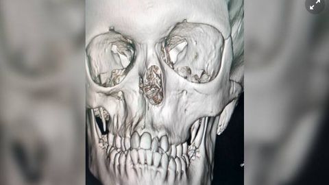 Rossiyada shifokorlar burunsiz tug‘ilgan 14 yoshli qizning burnini qayta tiklashdi