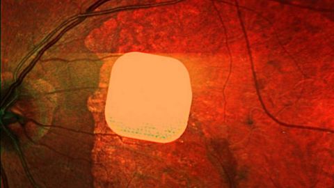 Soch tolasidan ham yupqa: ko‘zi ojizlar uchun mikrochipli implant yaratildi