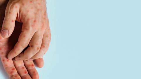 Қизамиқдан холи ҳисобланган Канадада касаллик эпидемияси қайд этилди