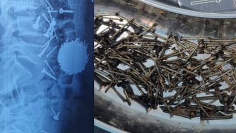 В Самарканде врачи извлекли из брюшной полости 29-летнего пациента около 200 граммов гвоздей