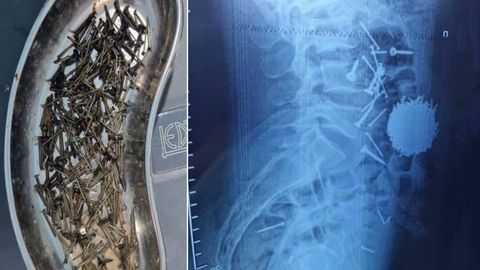 Samarqandda erkak stress sabab 200 gramm mix yutib yubordi