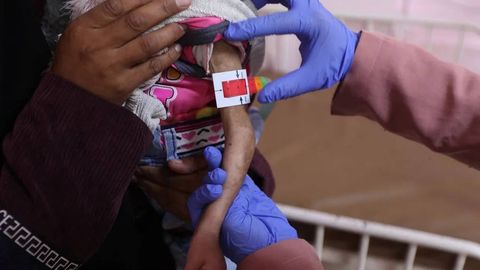 Ғазода тўйиб овқатланмасликдан азият чекаётган болалар 95 мингга етди