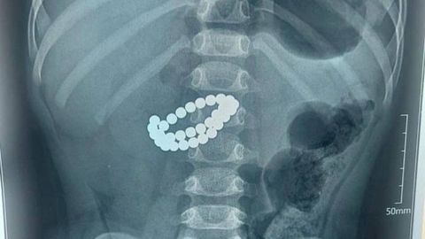 Қозоғистонда боланинг ичагидан 31 та магнит чиқариб олинди